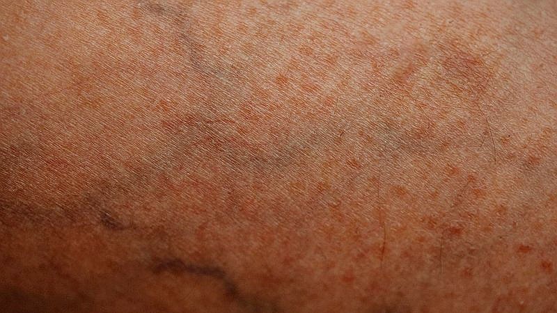 collagen for skin elasticity - health article image 2