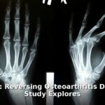 Semaglutide osteoarthritis - health article image 1