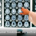 AI brain tumor treatment - health article image 1