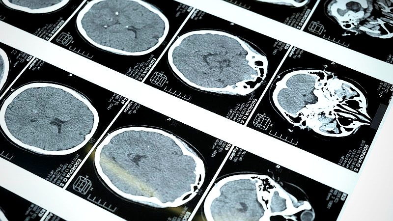 AI brain tumor treatment - health article image 3