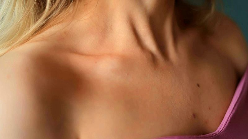 buffalo hump - health article image 3