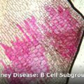 diabetic kidney disease - health article image 1