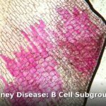 diabetic kidney disease - health article image 1