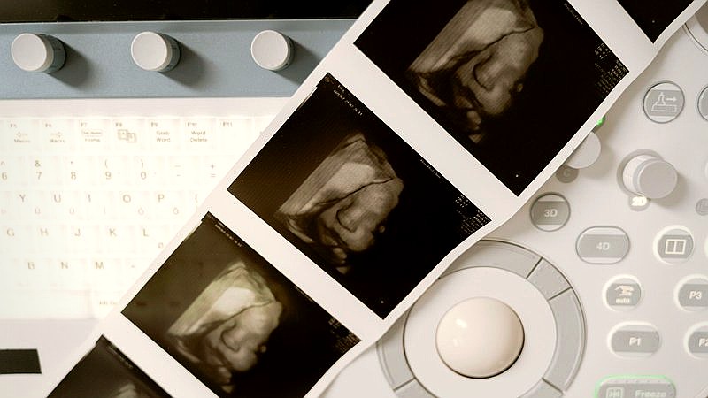 pioneering treatment twins - health article image 2