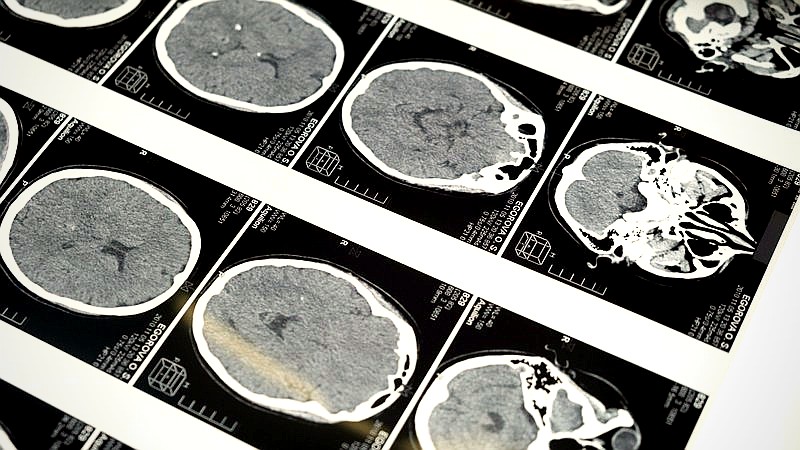 Columbia Alzheimer's research - health article image 2