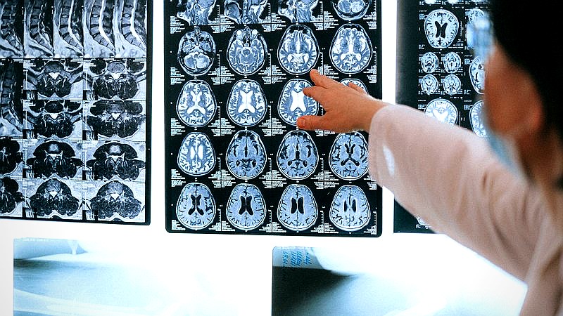 Columbia Alzheimer's research - health article image 3